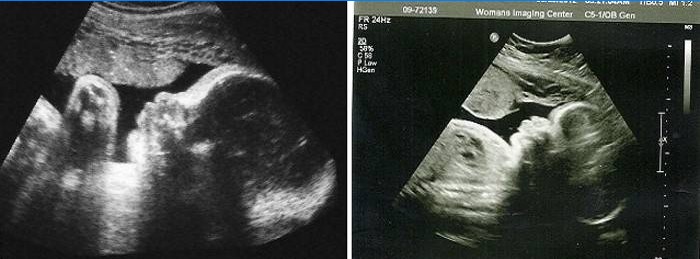 Ultrazvuk abdomena u 34. tjedna gestacije