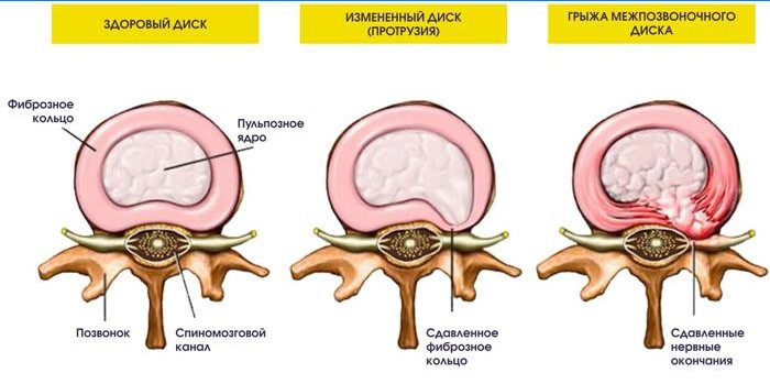 Protruzija i hernija intervertebralnog diska