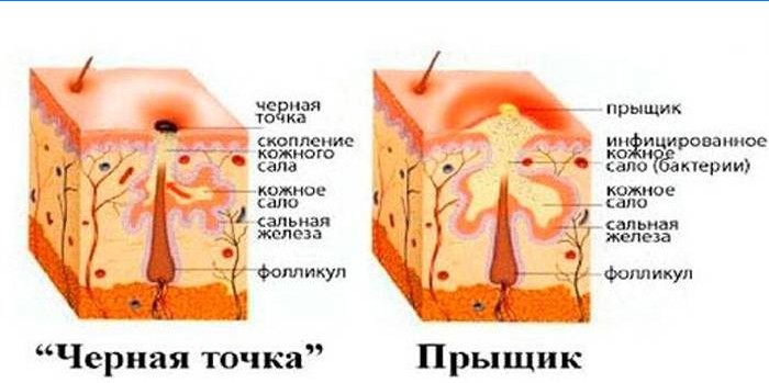 Кожное сало. Почему нельзя выдавливать прыщи. Прыщи нельзя давить причины. Гнойный прыщ с несколькими точками.