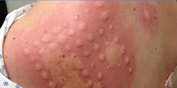 Alergijski test kože