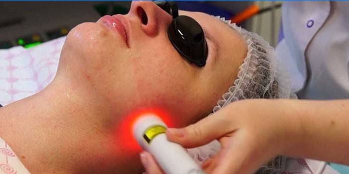 Laserska biorevitalizacija