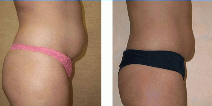 Djevojčin trbuh prije i nakon kavitacije