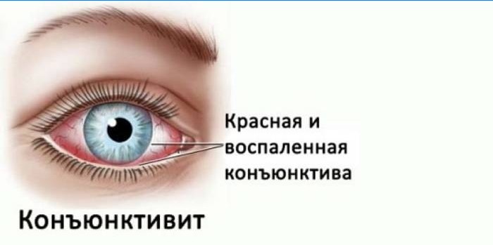 Konjunktivitis